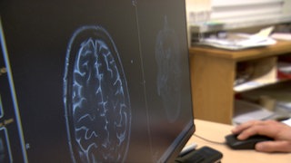 Scan eines Gehirns in der Klinik: Das Toskana-Virus kann in seltenen Fällen eine Hirnhautentzündung auslösen