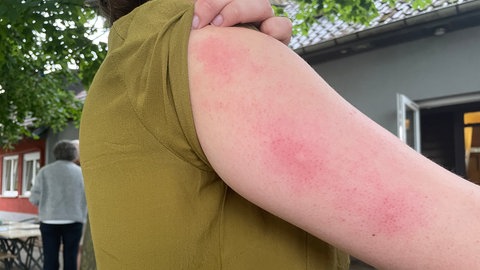 Die Folgen der Mückenstiche sind nicht schön.