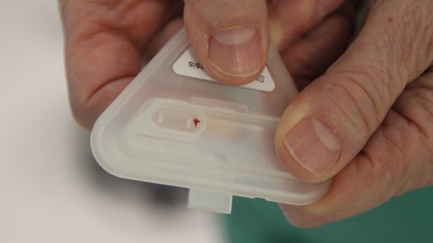 In einer Plastikdose ist etwas kleines Rotes. Es ist ein entfernter Steigbügel aus einem Innenohr.