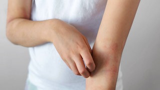 Ein Kind kratzt sich an der entzündeten, trockenen Haut am Arm, Juckreiz, Reizung, Rötung