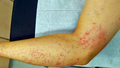 Hautausschlag auf dem Arm: Die Wasserqualität in EU-Badeseen wird regelmäßig kontrolliert. Saugwürmer-Larven, so genannte Zerkarien, verursachen oft einen juckenden Hautausschlag. (Archivbild)