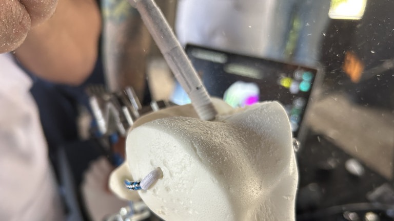 Hier kommt nur noch eine Fräse zum Einsatz, Sägen brauchen die Operateure dank der modernen Technik nicht mehr. 