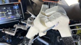 Ziel: schnell wieder laufen können! Dank der millimetergenauen Fräse ist alles so vorbereitet, dass das neue künstliche Kniegelenk perfekt passt. 