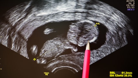 Die Ultraschallaufnahme eines Embryos im Mutterleib. Durch Alkoholkonsum in der Schwangerschaft kann das ungeborene Baby großen Schaden nehmen. 
