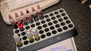 In Trier werden relativ viele Syphilis-Fälle registriert. Das Gesundheitsamt in Trier weiß mehr dazu und sagt: Kein Grund zur Panik.