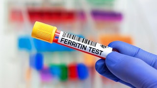 Blutprobe für einen Ferritin-Test: Bei Eisenmangel leidet der Sauerstofftransport im Blut, in der Folge ist der Körper weniger leistungsfähig. Und das gilt auch für das Gehirn. Wichtiger Marker: das Ferritin im Blutserum. 