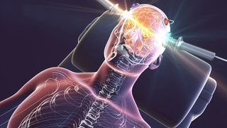 Elektrokonvulsionstherapie (EKT) (grafische Darstellung): Hirnstimulation ist oft die erste Behandlung, die bei therapieresistenten Depressionen überhaupt anschlägt. Neben der etablierten EKT helfen auch neuere Verfahren.