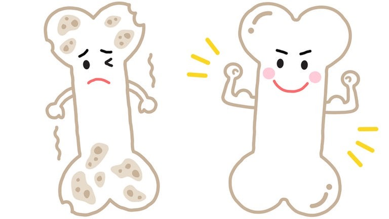 Osteoporose (Illustration): kranker "trauriger" Knochen und gesunder "fröhlicher" Knochen: Osteoporose betrifft in Deutschland rund 5,7 Millionen Menschen, vor allem Frauen nach der Menopause. Aber auch Männer kann es treffen. 