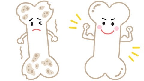 Osteoporose (Illustration): kranker "trauriger" Knochen und gesunder "fröhlicher" Knochen: Osteoporose betrifft in Deutschland rund 5,7 Millionen Menschen, vor allem Frauen nach der Menopause. Aber auch Männer kann es treffen. 
