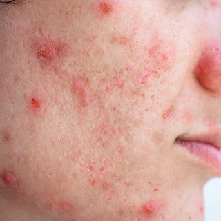 Symbolbild: Gesicht einer jungen Frau mit Akne und Pickeln