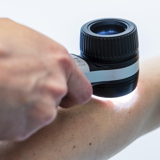 Dermatologische Untersuchung mit Dermatoskop an einem Unterarm