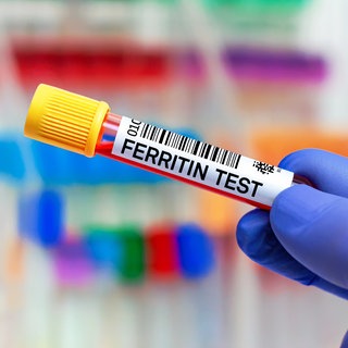 Blutprobe für einen Ferritin-Test: Bei Eisenmangel leidet der Sauerstofftransport im Blut, in der Folge ist der Körper weniger leistungsfähig. Und das gilt auch für das Gehirn. Wichtiger Marker: das Ferritin im Blutserum. 