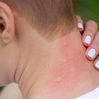 Eine Frau kratzt sich den Nacken, auf dem einige geschwollene Stiche zu sehen sind.