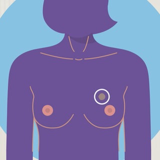 Piktogramm einer Frau mit einem Tumor in der Brust.