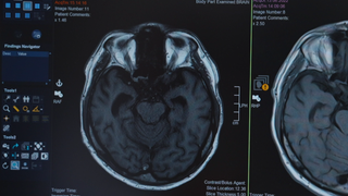 Alzheimer Diagnose