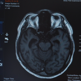 Alzheimer Diagnose