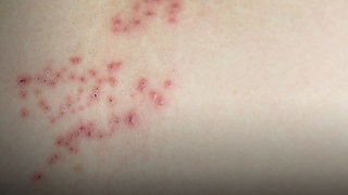 Ausschlag auf der Haut. Hier liegt eine Gürtelrose-Erkrankung vor.