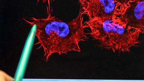 Hand zeigt auf Zellen-Wucherung durch Hautkrebs auf Computerbildschirm